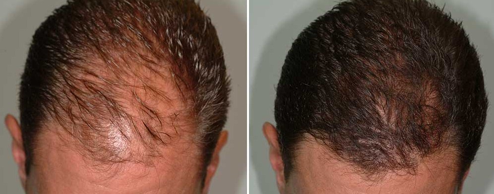 jual minyak kemiri dapat mengatasi kerontokan rambut