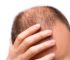 Obat Penumbuh Rambut Tradisional dapat menyembuhkan rambut rontok dan kepala botak