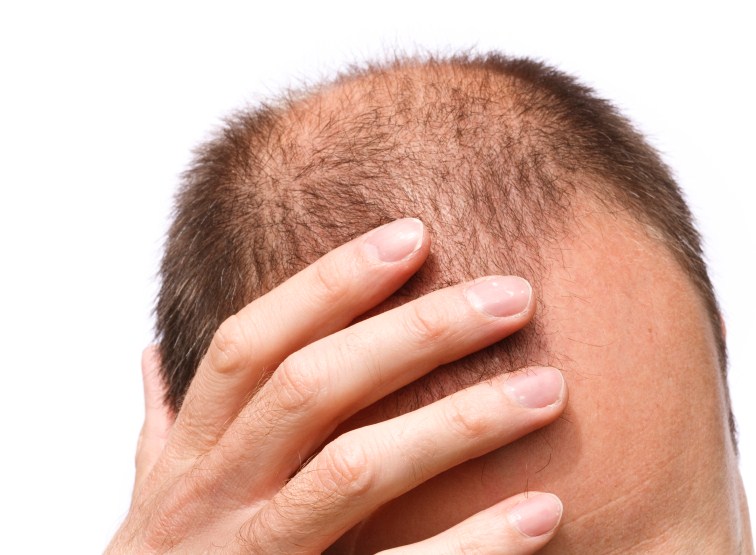 Obat Penumbuh Rambut Tradisional dapat menyembuhkan rambut rontok dan kepala botak
