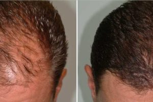 Jual Minyak Kemiri Kukui Murni untuk Rambut murni 100% berguna untuk melebatkan rambut, brewok, alis dan kumis. Setelah itu minyak kemiri bisa juga mengatasi rambut rontok dan ketombe.